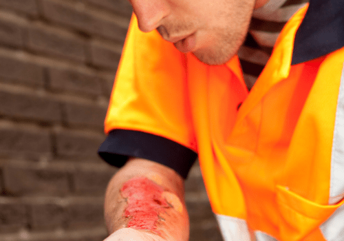 Burn Injury At Work | Workers Comp Lawyer| Raphael B. Hedwat